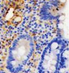 0012). No difference was present between immunohistochemical staining of crypt epithelium (P value = 1) (Table 3).