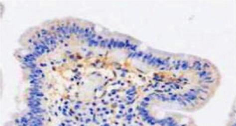 The results also showed that there is no significant difference in the pattern of ttg staining among cases of celiac disease versus chronic duodenitis due to inflammatory bowel disease.
