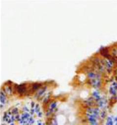 4 Pathology Research International Table 3: Immunohistochemical staining pattern in celiac disease and