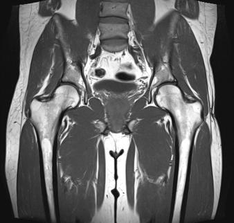 UW MEDICINE PATIENT EDUCATION MRI: Pelvis Scan How to prepare and what to expect This handout explains how an MRI scan of the pelvis works, how it is done, how to prepare for it, what to expect, and
