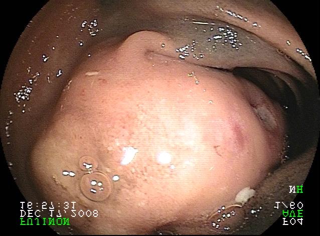 Bleeding ulcerated GIST Capsule Endoscopy in NRCD Case-control study of 42 NRCD and 84 age- and sex-matched controls who underwent CE.
