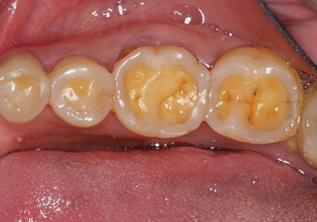 Osim atricije, bruksizam može dovesti do bolova u žvačnim mis ićima i poremećaja u temporomandibularnom zglobu (17). Stiskanje zubima čest je nalaz i kod konzumenata ecstasyja.