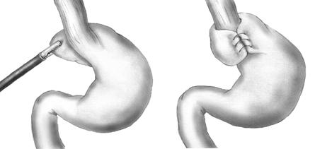 What is a Nissen Fundoplication? A fundoplication is a surgical procedure used to treat severe gastrooesophageal reflux disease (GORD).