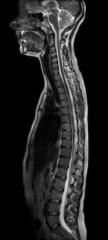 UW MEDICINE PATIENT EDUCATION MRI: Spine Scan How to prepare and what to expect This handout explains how an MRI scan of the spine works, how it is done, how to prepare for it, what to expect during