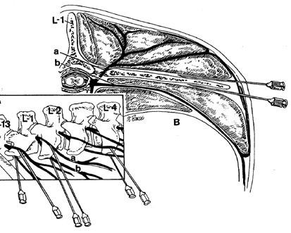 Proksimalni paravertebralni blok (Farquharson/Cambridge block) poslednji torakalni i prva dva lumbalna nerva se blokiraju odmah, na mestu izlaska iz intervertebralnog otvora.