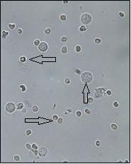 Klinički značaj pronalaska eritrocita Male bikonkavne stanice bez jezgre su eritrociti. Mogu poprimiti izgled kotačića ako nabubre ili biti isprekidanog ruba ako se stisnu u koncentriranoj mokraći.