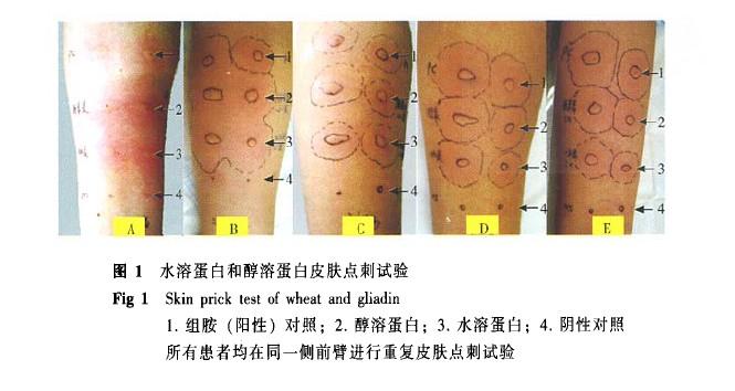 Wheat-dependent Exercise-induced Anaphylaxis Yin Jia