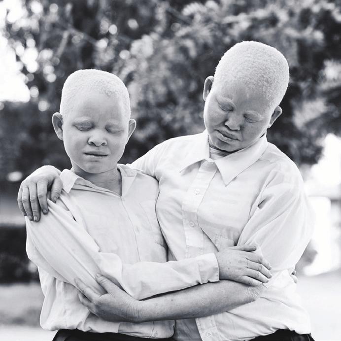 This festive season light a life with a child that has albinism. We are human too!