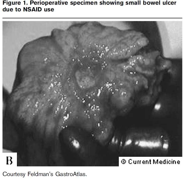 NSAID and Small Bowel NSAID Use Fortun PJ Curr Opin Gastroenterol 2005 Mar;21(2):169-75 The Perfect Storm: Over past 30 years We grow wheat