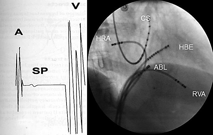 atrijske tahikardije odnosno atrijske fibrilacije jer je tada ventrikulski odgovor vrlo brz (> 250-300/min).