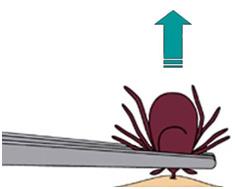 An adult should use narrow tweezers to pull the tick straight up and out.