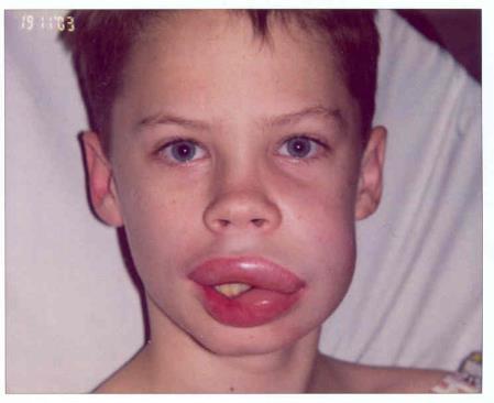 can be quite severe Angioedema