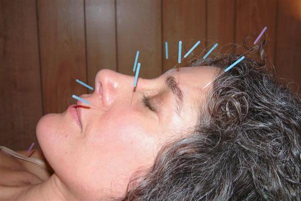 Terms to Know Acupuncture - practice of sticking
