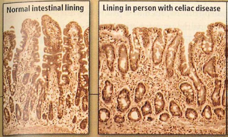1/21/15 Celiac Disease Classic Autoimmune disease Chronic= Lifelong Organ specific= Small intestines Damage done by White
