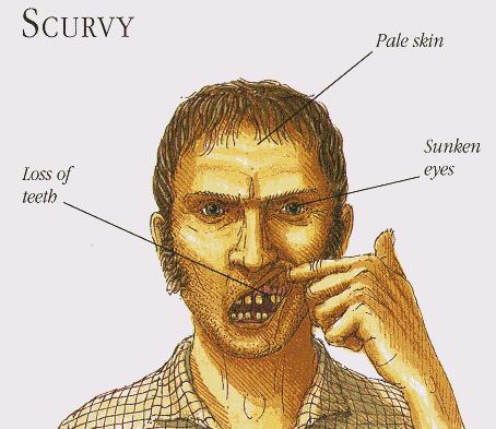 Scurvy was a disease that plagued sailors.