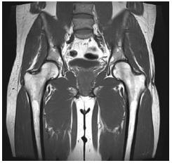 UW MEDICINE PATIENT EDUCATION MRI: PELVIS SCAN VIETNAMESE Chụp MRI: Khung Xương Chậu Làm thế nào để chuẩn bị và sự việc sẽ như thế nào Tài liệu này giải thích việc chụp MRI ở xương chậu sẽ như thế
