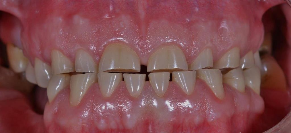 lokalizacija na mjestima koja su podložna samočis ćenju kao s to su bukalne plohe i opsežne destrukcije aproksimalnih ploha prednjih zubi (14). 5.2.