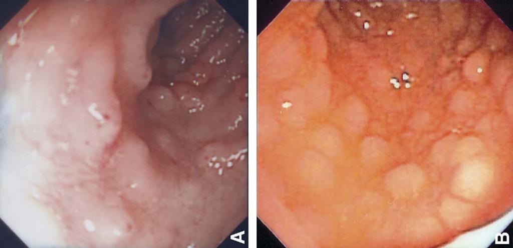 Duodenal Bulb Nodularity: an endoscopic sign of cow s milk protein allergy in