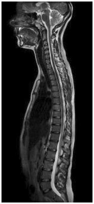 UW MEDICINE PATIENT EDUCATION MRI: SPINE SCAN VIETNAMESE Chụp MRI: Cột Sống Làm thế nào để chuẩn bị và sự việc sẽ như thế nào Tài liệu này giải thích việc chụp MRI cột sống sẽ như thế nào, được thực