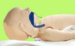 Otvaranje dišnog puta kod djeteta starog do godinu dana gdje ne sumnjamo na ozljedu Kod dojenčeta (dijete do jedne godine starosti) glavu postavite u neutralni položaj tako da mu je os uha