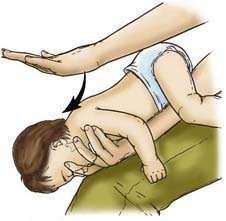 Postupak kod djece do godine dana - Ne provodi se Heimlichov hvat. Umjesto toga dijete treba položiti potrbuške na svoju podlakticu tako da glava leži na dlanu i usmjerena je prema dolje.