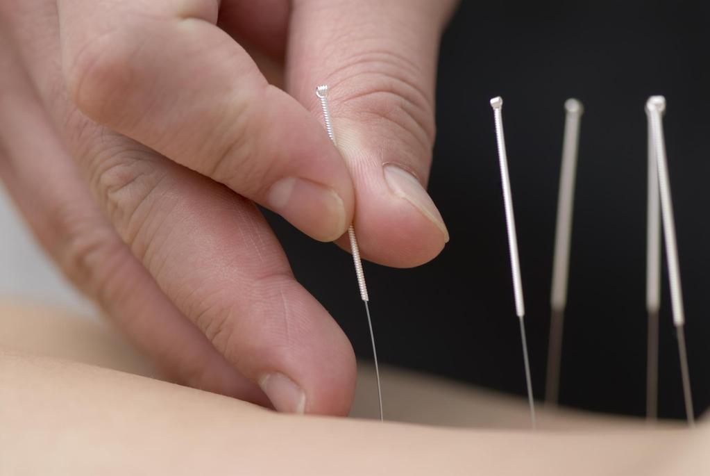 A is for acupuncture Acupuncture is the practice of inserting needles into a certain point in